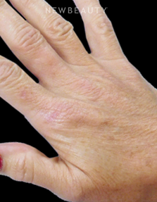 Dr. Kenneth R. Beer - Hand Rejuvenation - After
