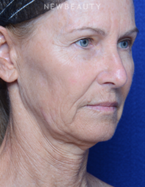Dr. Alan Durkin - Facelift - Before