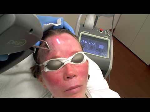 Dr. Jacono – Mini Face Lift With Pearl Laser