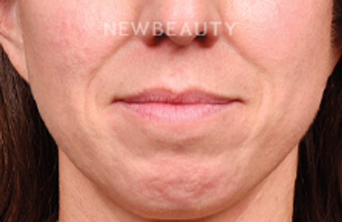 Dr. James Bouzoukis – Lip Enhancement, Cheek Augmentation and Restylane – 52911067 - Before