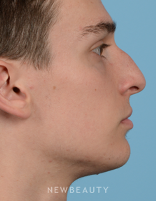 Dr. Jeffrey Wise - Rhinoplasty - Before
