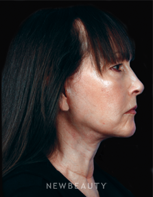 Dr. Kelly Bomer Facelift - After