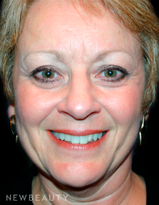 Dr. Kelly Bomer Liquid Facelift - Before