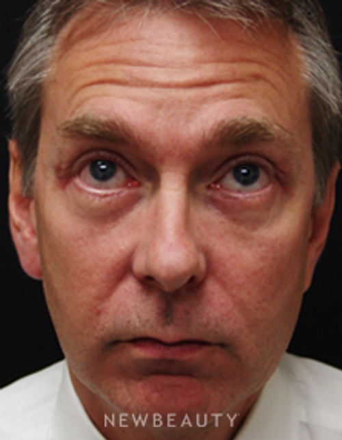 Dr. Mokhtar Asaadi Eyelid Lift - After