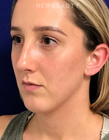 Dr. Dilip Madnani - Lower Blepharoplasty - After