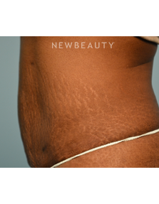 Dr. Ruth Hillelson - Thermage - After