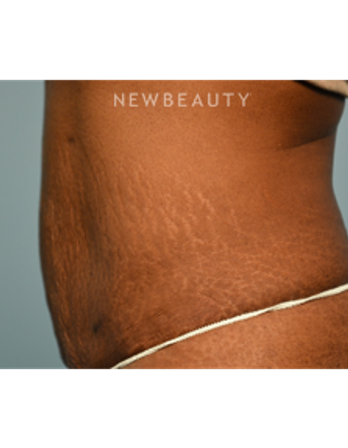 Dr. Ruth Hillelson - Thermage - After