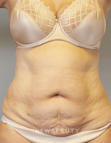 Dr. Henry Mentz - Tummy Tuck - Before