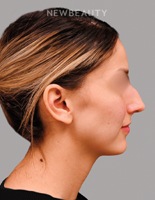 Dr. Shahin Fazilat - Rhinoplasty - 46267418 - Before