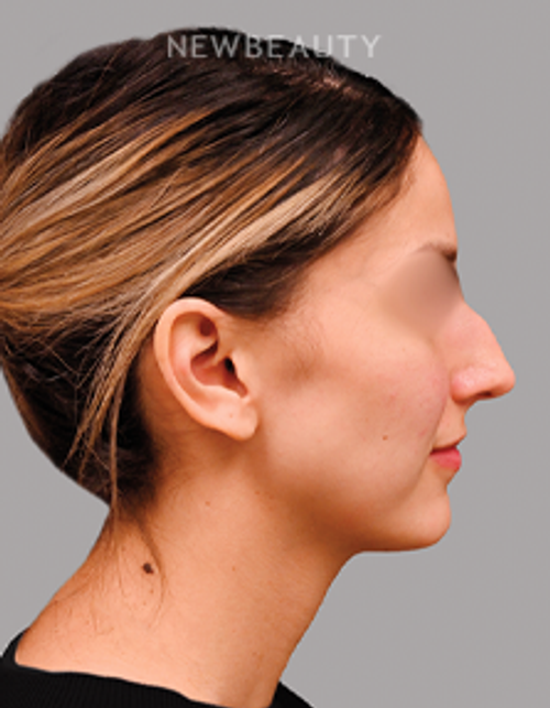 Dr. Shahin Fazilat - Rhinoplasty - 46267418 - Before