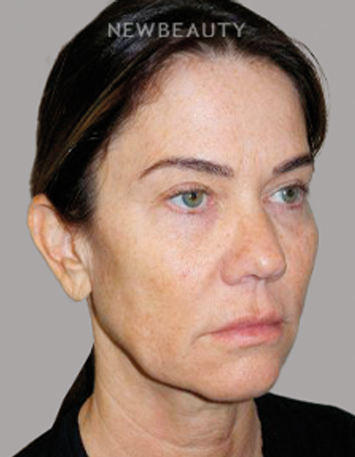 Dr. Sanjay Grover - Facelift - 49726344 - Before