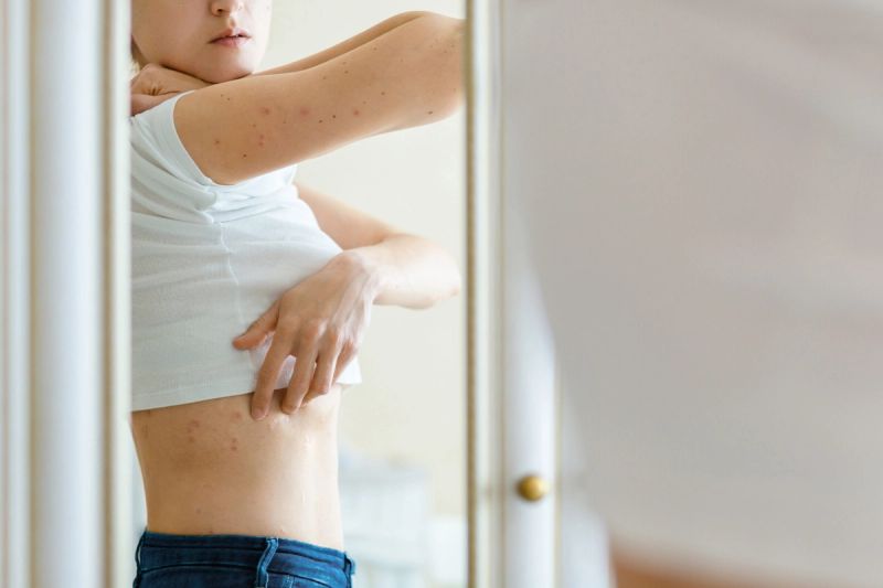woman with eczema itching body in mirror