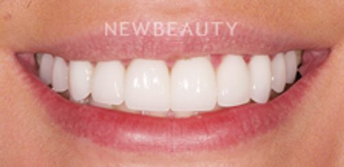 Dr. Salvator La Mastra - Smile Makeover -46106752 - After