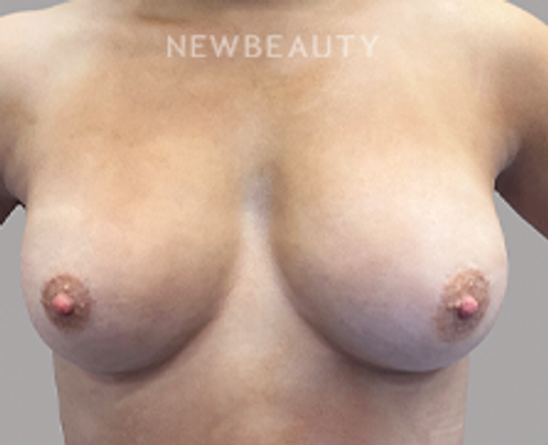 Dr. Christine Hamori – Breast Augmentation – 52892616 - After
