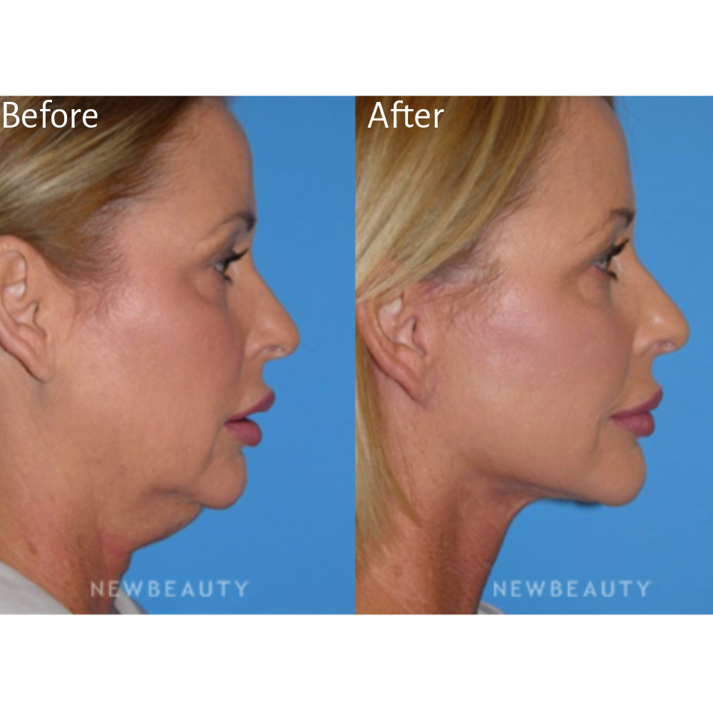 Treatment: Facelift
