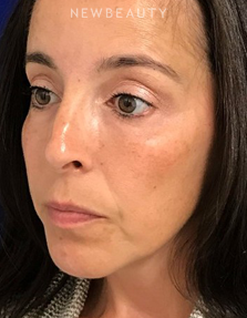 Dr. Dilip Madnani - Cheek Filler - After