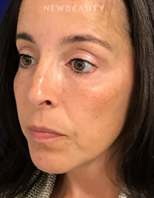 Dr. Dilip Madnani - Cheek Filler - After