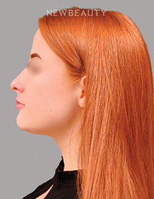 Dr. Shahin Fazilat - Liposuction - 46267441 - After