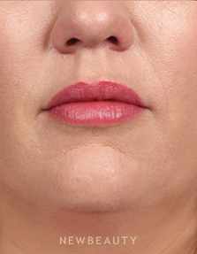 Dr. Kelly Bomer - Lip Enhancement - After