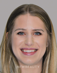 Dr. Nathan Hoffman - Smile Makeover - Before