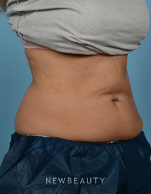 Dr. Jeffrey Wise - CoolSculpting - After