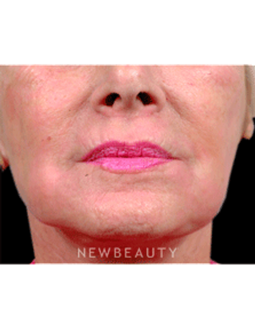 Dr. Steven Bloch Lasers and Light-Based Treatments - After