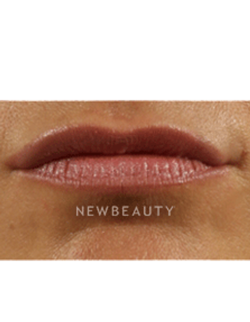 Dr. Marina Peredo Lip Augmentation - After