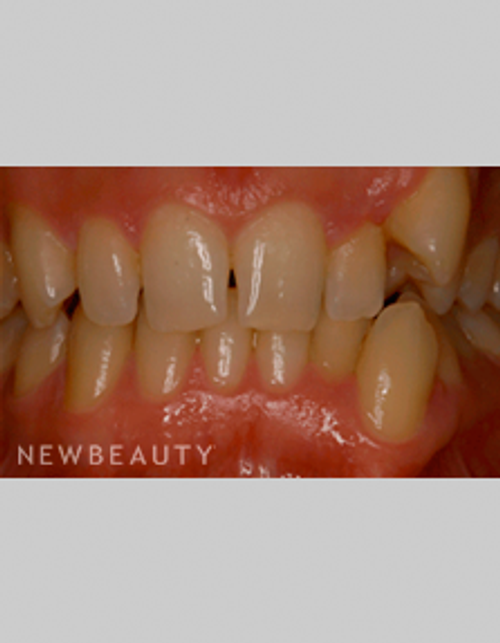 Dr. Bob Perkins Veneers, Orthodontics - Before