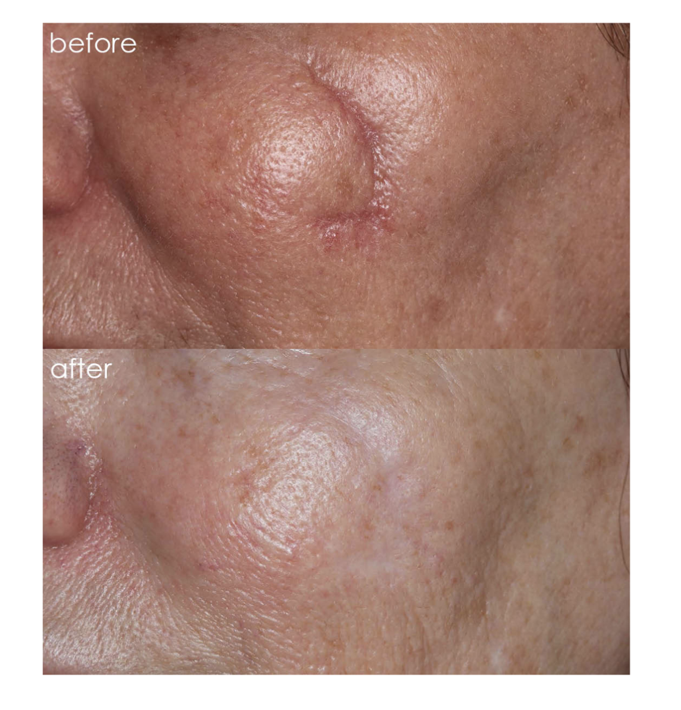 facial scar before and after