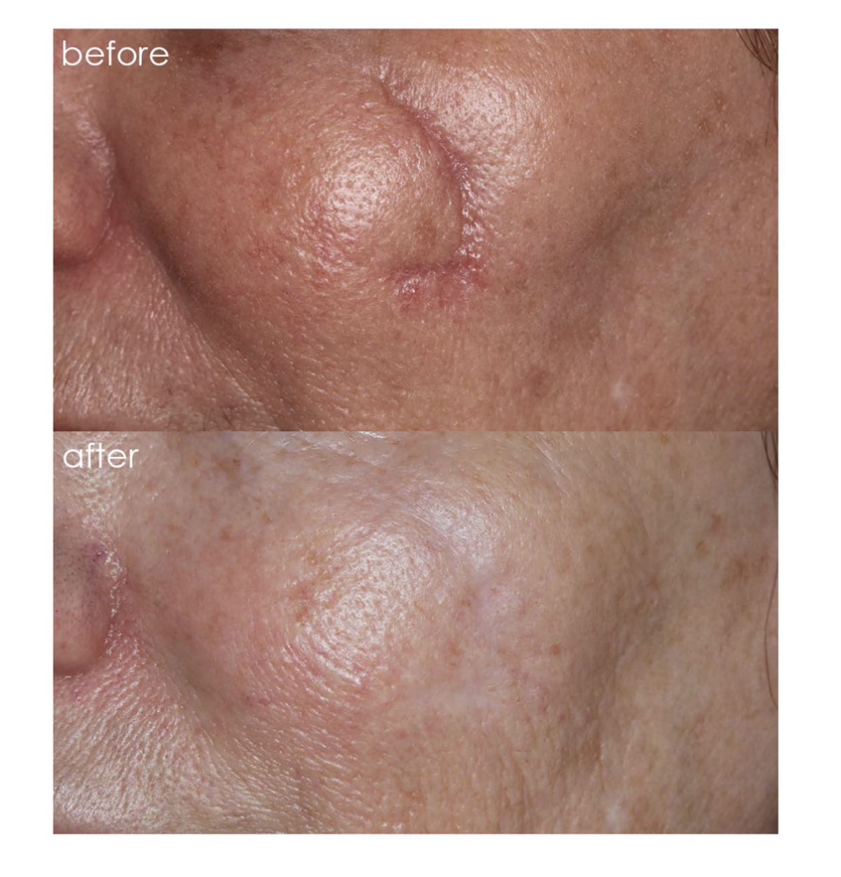 facial scar before and after