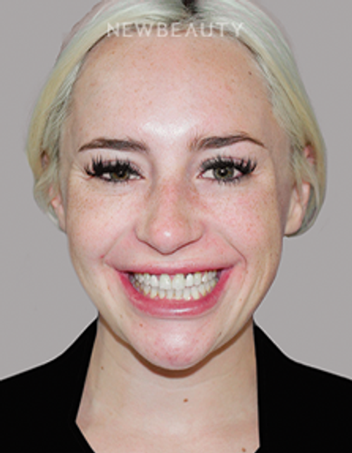 Dr. Salvator La Mastra - Smile Makeover -46109281 - Before