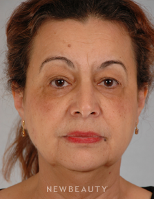 Dr. Henry Mentz Eye Lift, Facelift, Necklift - Before