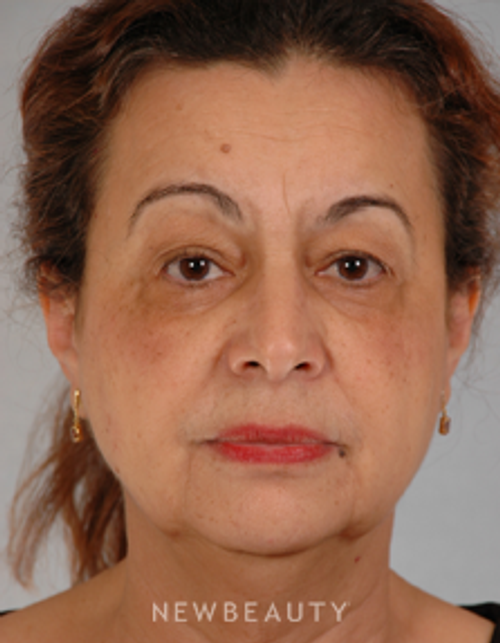Dr. Henry Mentz Eye Lift, Facelift, Necklift - Before