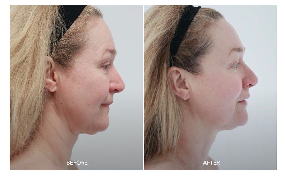 SKORR GLOW BEORE AND AFTER