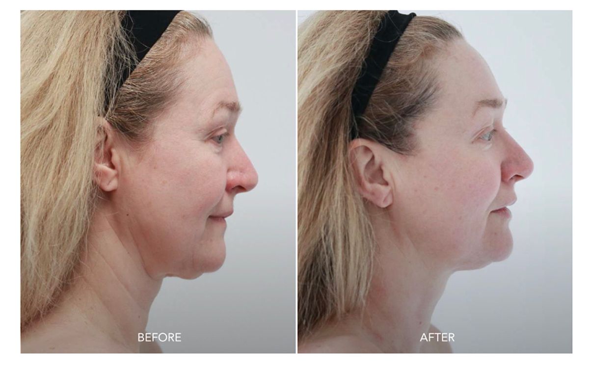 SKORR GLOW BEORE AND AFTER