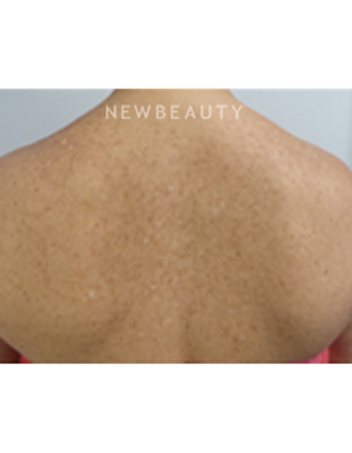 Dr. Marina Peredo - and more. Skinfluence “Trinity Treatment” - After