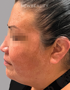 Dr. Anna Chacon - Melasma - 34280278 - Before