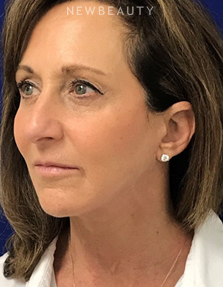 Dr. Dilip Madnani - Facelift - After