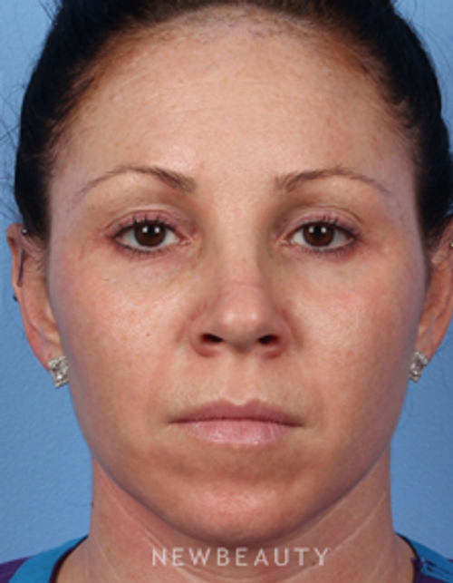 Dr. Kelly Bomer - Lasers - After