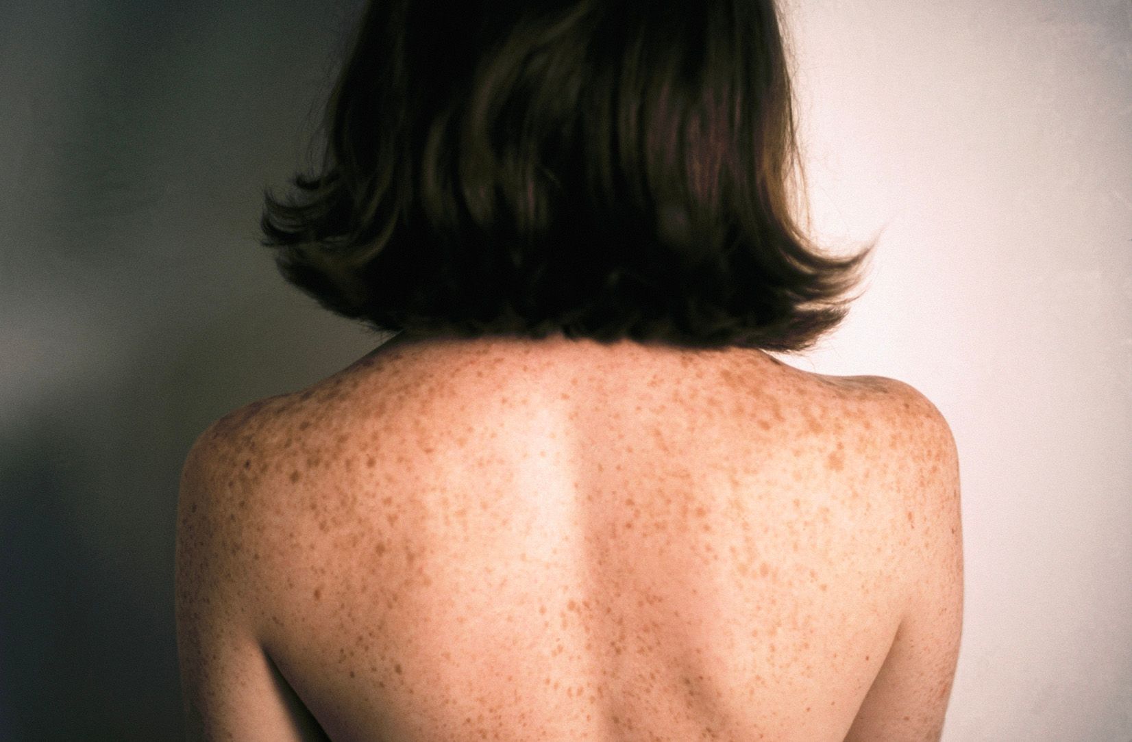 What Are Those White Sun Spots on My Skin?