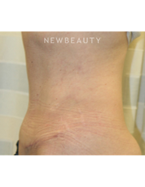 Dr. Christine Hamori - Tummy Tuck - After