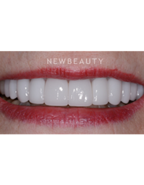 Dr. Guy Lewis - Smile Makeover - After