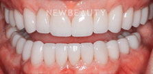 Dr. Joseph Field - Veneers - 20258337 - After