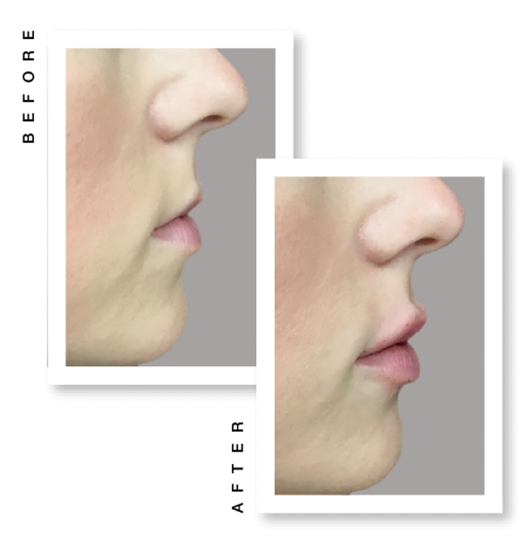 Restylane Kysse Restylane Kysse