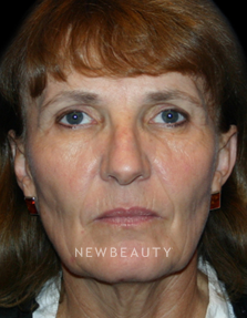 Dr. Kelly Bomer Facelift, Necklift - Before