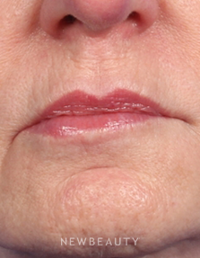 Dr. Kelly Bomer – Lip Filler - Before