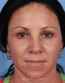 Dr. Kelly Bomer - Lasers - Before