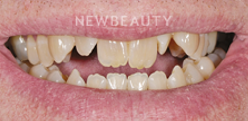 Dr. Salvator La Mastra - Smile Makeover -46106612 - Before