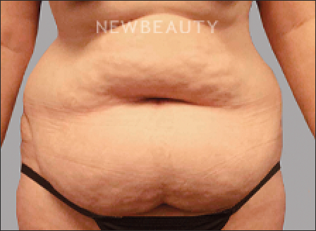 DR. AMY M. SPROLE - Tummy Tuck - 46920185 - Before
