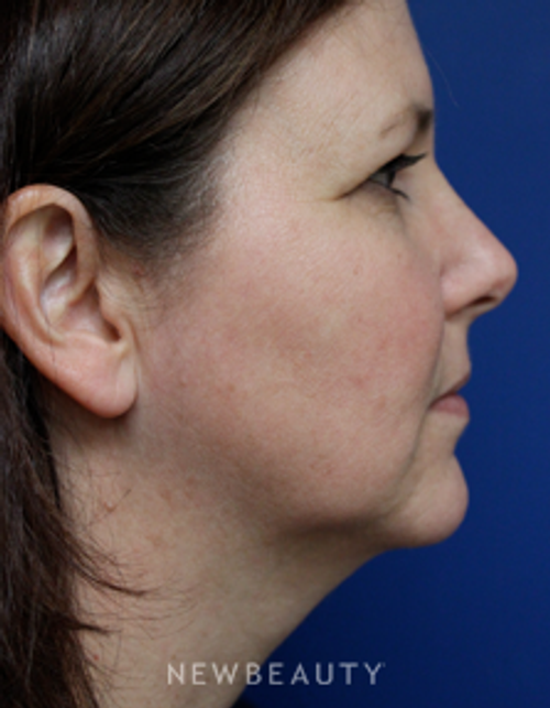 Dr. Joseph Russo - A Balanced Facial Profile - Before